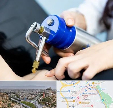 کرایوتراپی در معالی آباد شیراز