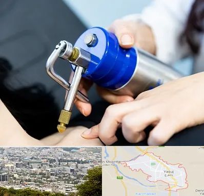 کرایوتراپی در یاسوج