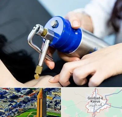 کرایوتراپی در گنبد کاووس