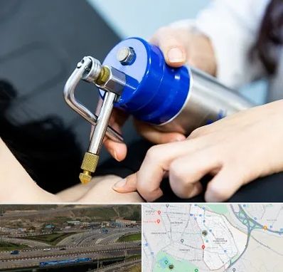 کرایوتراپی در یاغچیان تبریز