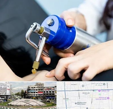 کرایوتراپی در مرکز تهران