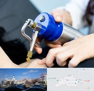 کرایوتراپی در ماهدشت کرج 