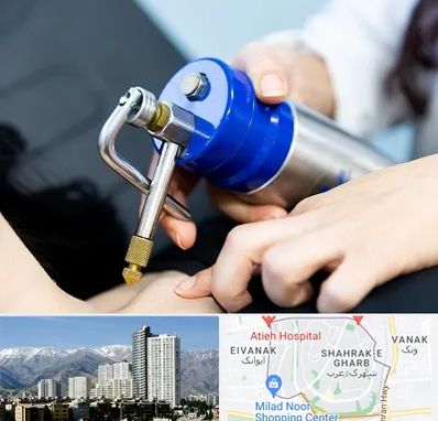 کرایوتراپی در شهرک غرب 