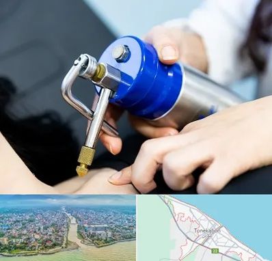 کرایوتراپی در تنکابن