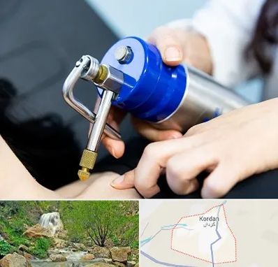 کرایوتراپی در کردان