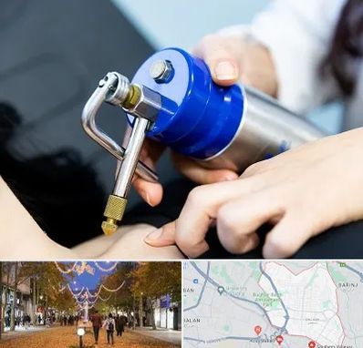 کرایوتراپی در ولیعصر ارومیه