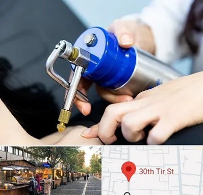 کرایوتراپی در سی تیر