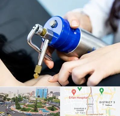 کرایوتراپی در ونک 