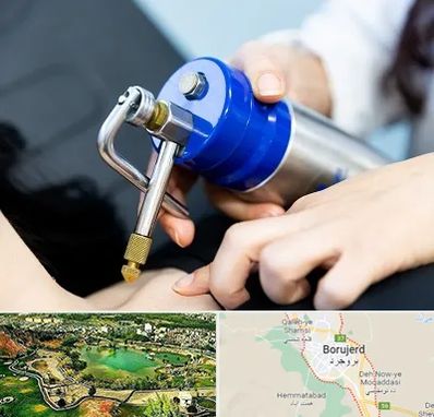 کرایوتراپی در بروجرد