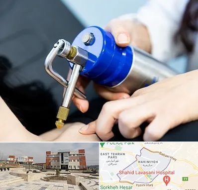 کرایوتراپی در حکیمیه 