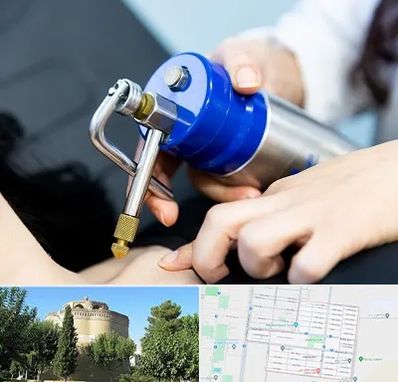 کرایوتراپی در مرداویج اصفهان