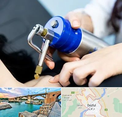 کرایوتراپی در دزفول