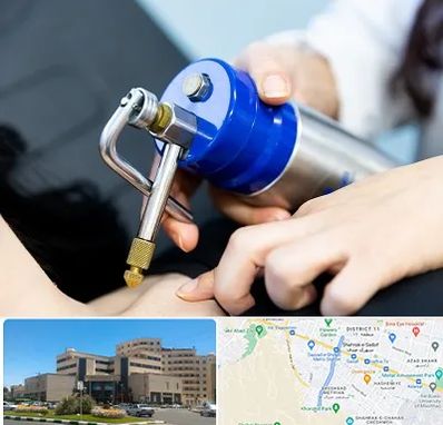 کرایوتراپی در صیاد شیرازی مشهد