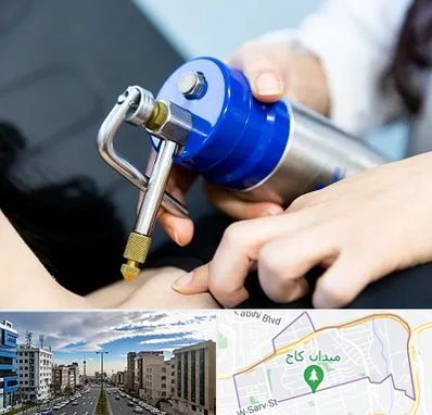 کرایوتراپی در سعادت آباد 