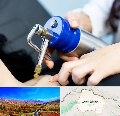 کرایوتراپی در خراسان شمالی