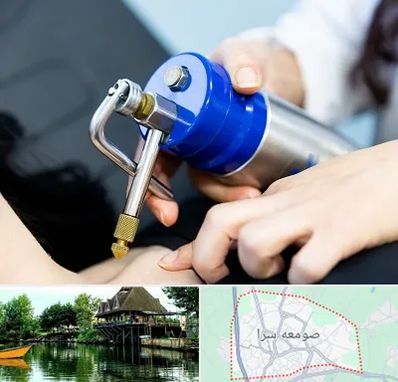 کرایوتراپی در صومعه سرا