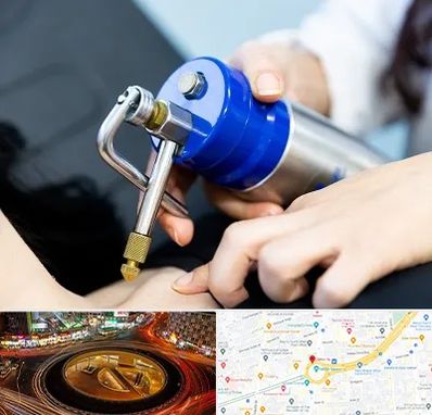 کرایوتراپی در میدان ولیعصر 