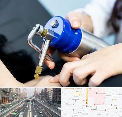 کرایوتراپی در توحید 