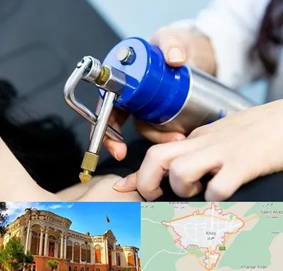 کرایوتراپی در خوی