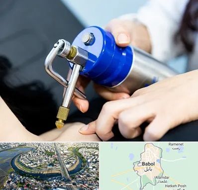 کرایوتراپی در بابل