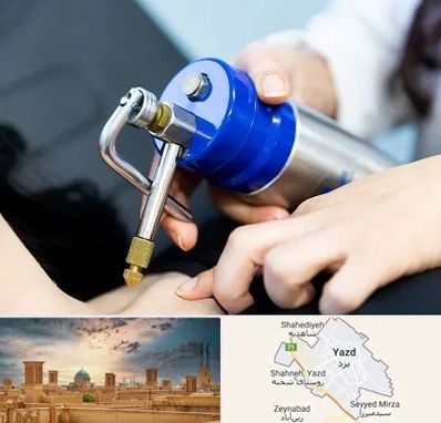 کرایوتراپی در یزد