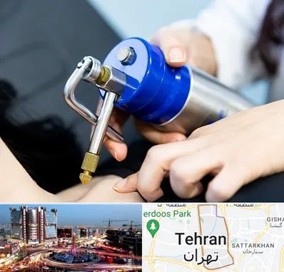 کرایوتراپی در صادقیه 