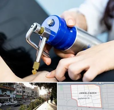 کرایوتراپی در خیابان جمالزاده