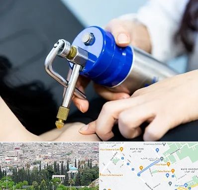 کرایوتراپی در محلاتی شیراز