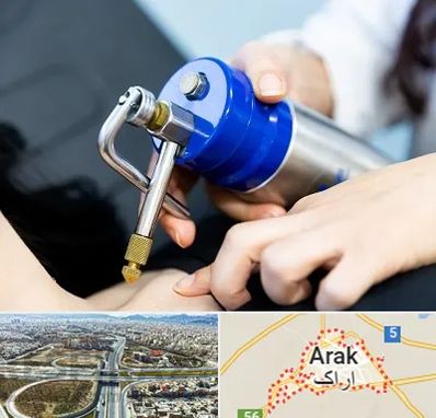 کرایوتراپی در اراک
