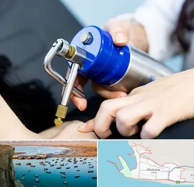 کرایوتراپی در چابهار