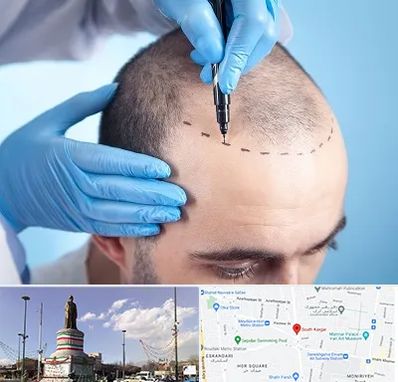 دکتر کاشت مو در کارگر جنوبی 