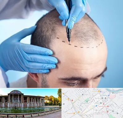 دکتر کاشت مو در عفیف آباد شیراز