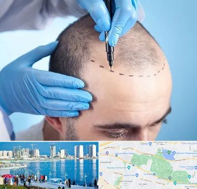 دکتر کاشت مو در چیتگر 