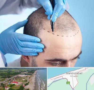 دکتر کاشت مو در محمودآباد