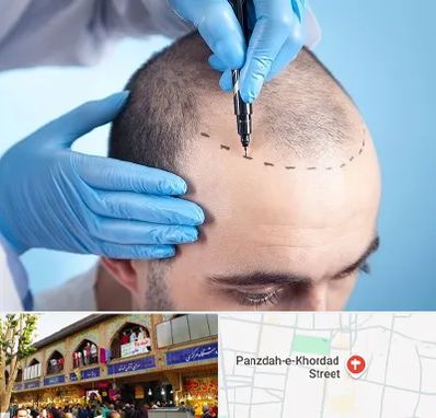 دکتر کاشت مو در 15 خرداد