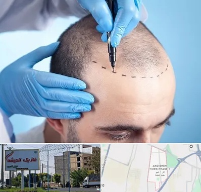 دکتر کاشت مو در فاز یک اندیشه