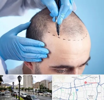 دکتر کاشت مو در شمال غرب تهران