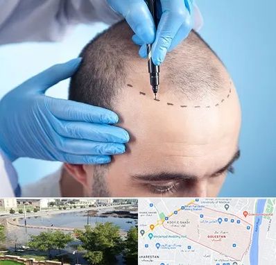 دکتر کاشت مو در گلستان اهواز