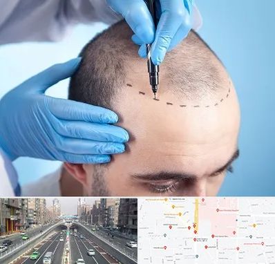 دکتر کاشت مو در توحید 