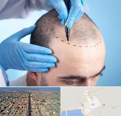 دکتر کاشت مو در بندر ماهشهر