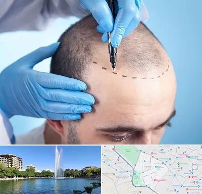 دکتر کاشت مو در کوهسنگی مشهد