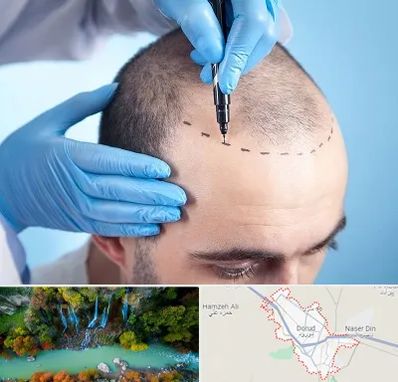 دکتر کاشت مو در دورود