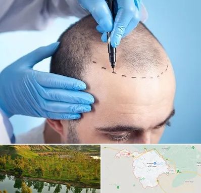 دکتر کاشت مو در بهبهان