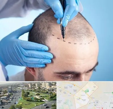 دکتر کاشت مو در کمال شهر کرج 