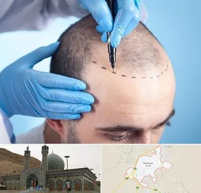 دکتر کاشت مو در شهرضا