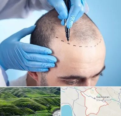 دکتر کاشت مو در گچساران