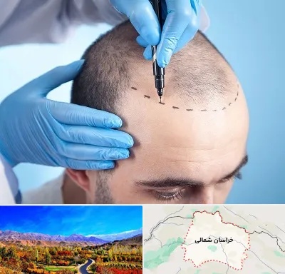 دکتر کاشت مو در خراسان شمالی