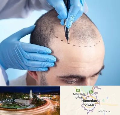 دکتر کاشت مو در همدان