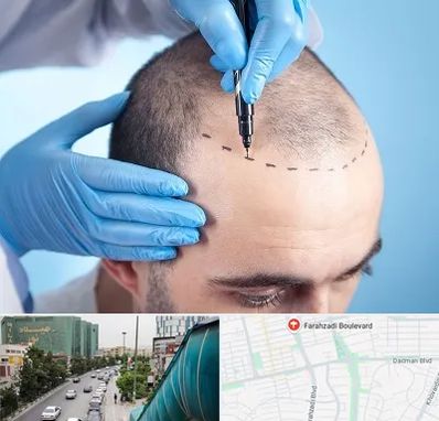 دکتر کاشت مو در بلوار فرحزادی