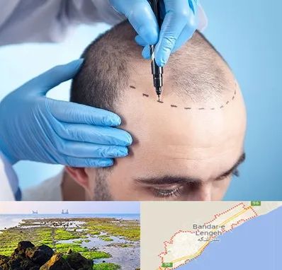 دکتر کاشت مو در بندرلنگه